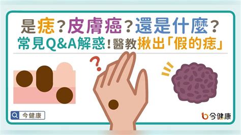 臉上多了痣|是痣？皮膚癌？還是什麼？常見Q&A解惑！醫教揪出「。